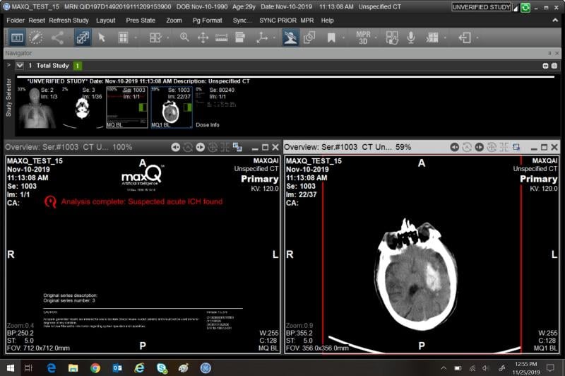 An algorithm developed by MaxQ identifies a CT slice image with signs of a suspected acute intracranial hemorrhage. GE Healthcare is integrating the algorithm and other smart software from third-party vendors into its Edison Open AI Orchestrator. Screenshot courtesy of GE Healthcare
