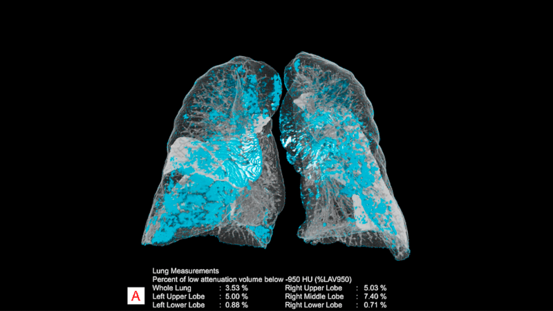 A smart algorithm from Siemens Healthineers analyzes and quantitates measurements in chest CT images.