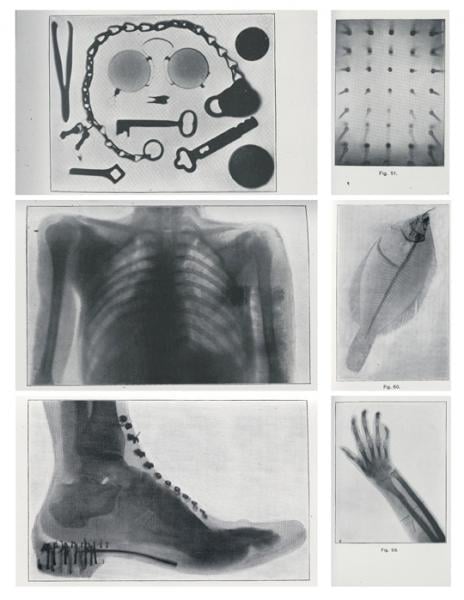 Early historical examples of the use of X-Ray 