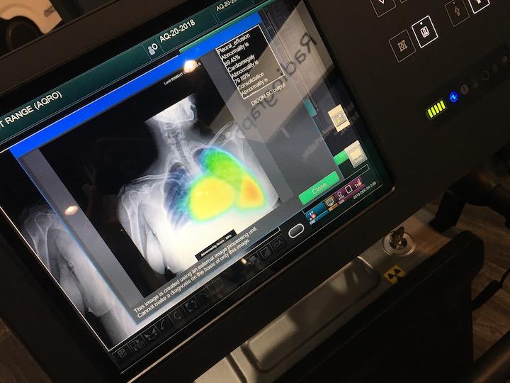 This is artificial intelligence on Fujifilm's mobile digital radiography system to immediately detect pneumothorax (a collapsed lung) and show the location to the technologist and attending physician in a unit before the image is even uploaded to the PACS for a read. AI applications like this that have immediate impact on critical patient care saw a lot of interest at RSNA 2019. 