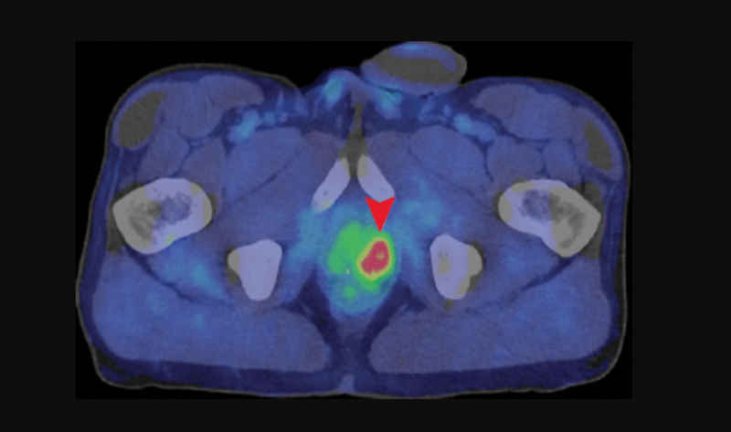 Axial fused PET/CT image shows intense uptake (arrowhead) in the deep pelvis corresponding to the left lobe of the prostate in a 62-year-old with a history of prostate cancer treated with radiation therapy.  The CT scan does not show the tumor. Image courtesy of the the Radiological Society of North America.