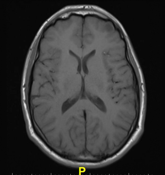 Contrast Agent Linked With Brain Abnormalities on MRI 