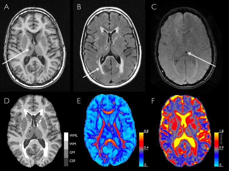 Structural and microstructural brain changes on MRI.