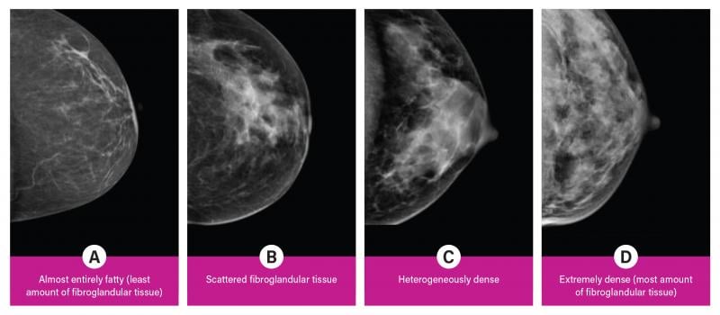 Breast density is divided into four categories, from lowest to highest amounts of fibroglandular tissue composition. Category A: Almost entirely fatty (least amount of fibroglandular tissue). Category B: Scattered fibroglandular tissue. Category C: Heterogeneously dense. Category D: Extremely dense (most amount of fibroglandular tissue).