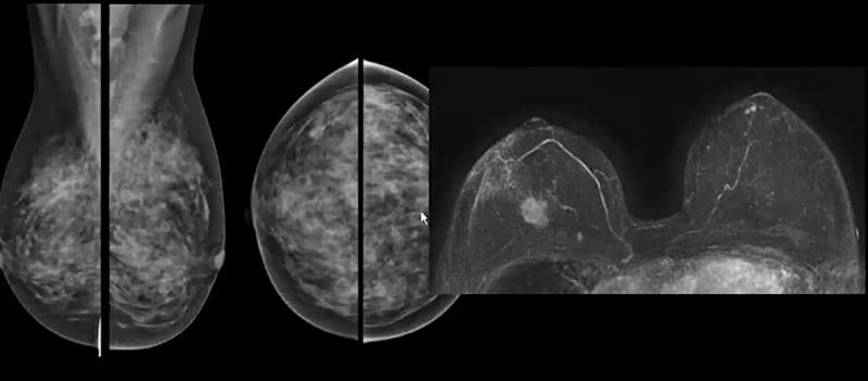 A comparison of a standard mammogram of a woman with dense breast tissue and her breast MRI, clearly showing a cancer that is not visible on the mammogram. Image from Christiane Kuhl, M.D.