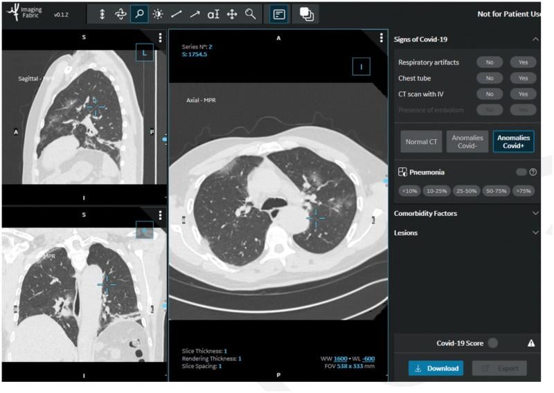 In the STOIC study, readers classified CT exams as COVID positive, COVID negative or normal. The readers had access to the CT scans using a 3D image visualization web application, allowing scrolling through the entire lung volume in the coronal, sagittal or axial transverse plane. The CT scan shown here has been classified as COVID positive due to the presence of bilateral ground glass opacities and absence of features such as mucoid impaction, bronchiolar nodules, segmental, lobar consolidation. RSNA Image