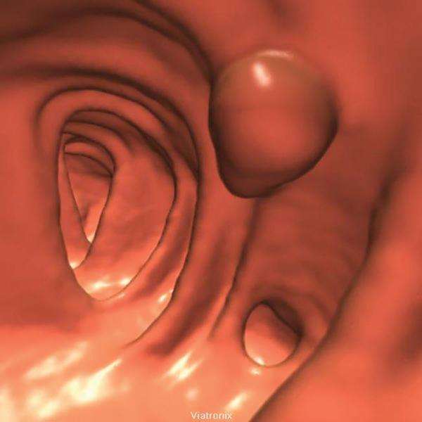 A screenshot of a polyp seen on a virtual fly-through of the colon