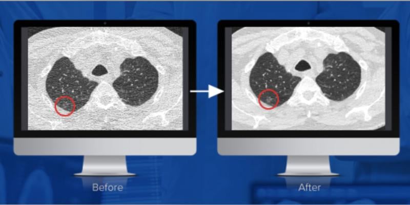 Studies conducted by Mass General Hospital and University of Virginia have concluded that PixelShine, a disruptive technology from AlgoMedica, significantly improved the diagnostic quality of CT scans acquired at reduced radiation dose. Here, you can see before and after noise reduction is applied.
