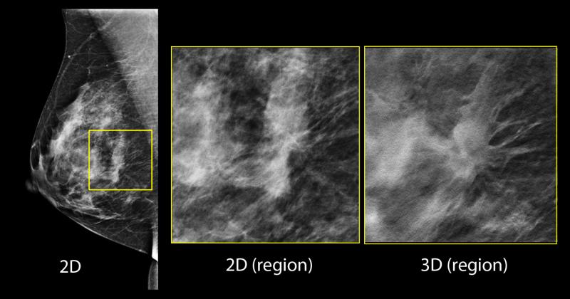 In the screening 2-D mammogram (left image), there is a possible lesion in the central breast, but its margins are difficult to assess. Using tomosynthesis this can be clearly seen to be a spiculated mass, and almost certainly a malignancy.