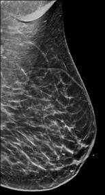 BI-RADS Category B: Scattered fibroglandular tissue. Dense Breasts. Breast density scale