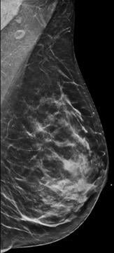 BI-RADS Category C: Heterogeneously dense. Dense Breasts can hide breast cancers.