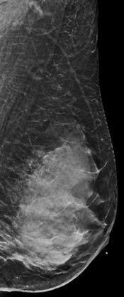 BI-RADS Category D: Extremely dense (most amount of fibroglandular tissue). Dense Breasts hide breast cancers.