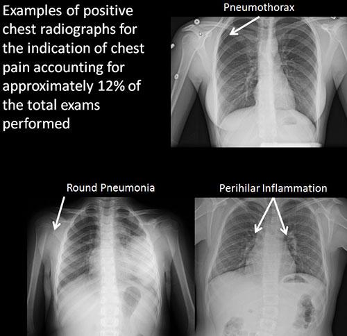 children, x-rays, Mayo Clinic, unnecessary, RSNA 2014, study