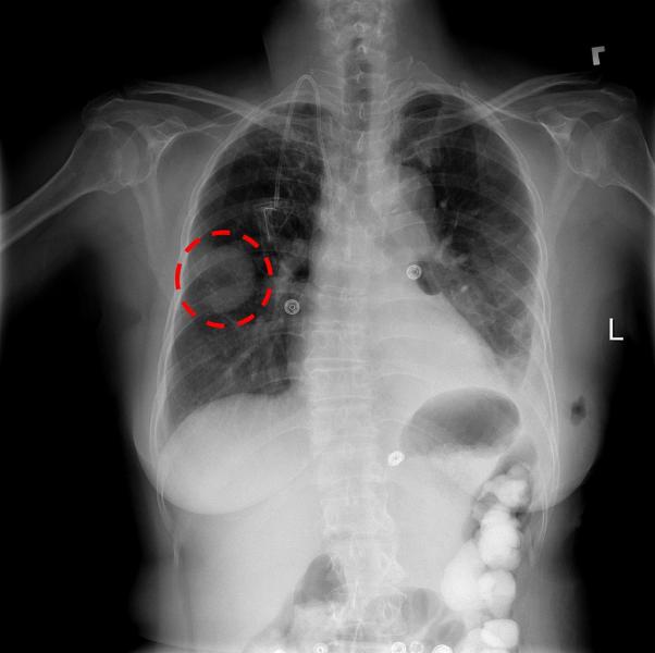 Chest X-ray AI Algorithm Correctly Identifies Lung Disease for Dubai Health Authority