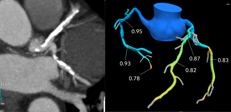This example of a coronary CT exams on the left shows what looks like severe coronary blockages due to calcified plaques. However, the FFR-CT image of the right  shows the FFR analisys and no stent is needed.  Imaging courtesy of Beaumont Hospital in Royal Oak, Mich.
