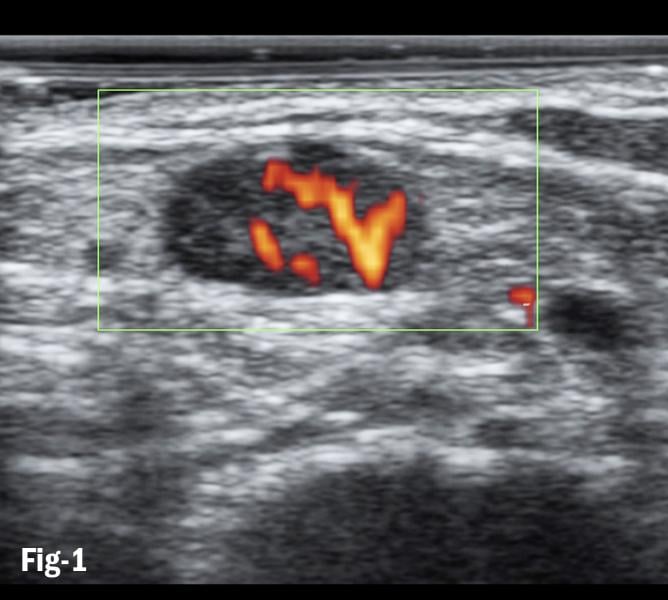 Figure 1. Doppler flows in subpleural consolidation shows smoothly dilated branching arteries 
