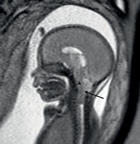 Fetal MRI image on Philips Ingenia 1.5T