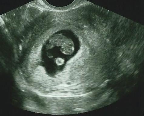 A transvaginal ultrasound image of a fetus at eight weeks. Imaged using a Philips HD15 system. Vivian Fornell