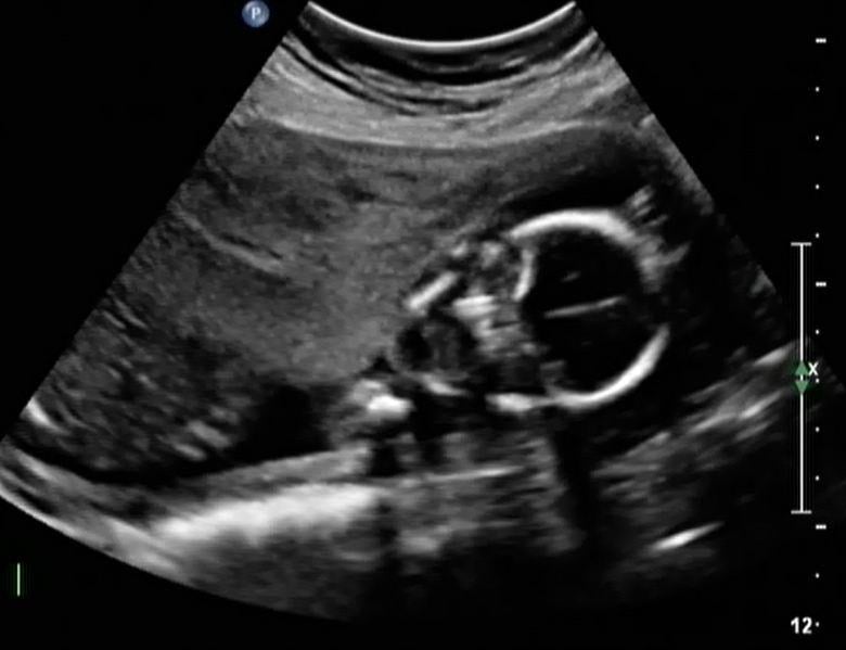 Fetal ultrasound showing the face, skull of the fetus and the placenta (gray mass to left). Katherine Fornell.  This is a baby ultrasound, also referred to as fetal ultrasound, OB ultrasound or prenatal ultrasound.