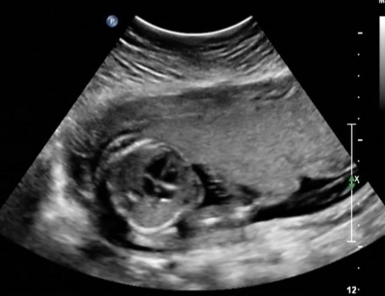 Fetal picture of ultrasound showing four-chamber view of the heart. 