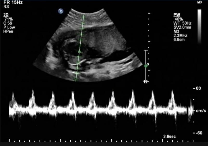 Fetal heart with Doppler heartbeat waveform, showing a normal cardiac evaluation. Katherine Fornell. This is a fetal echocardiogram or baby echo ultrasound picture. .