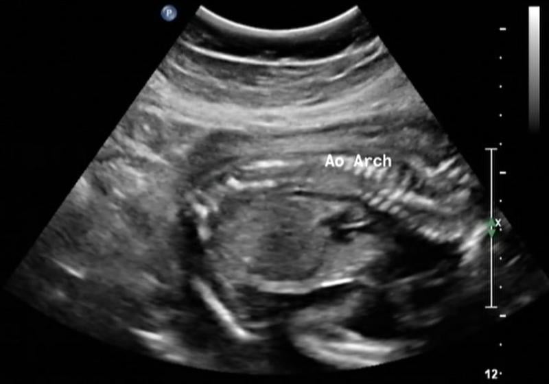 Fetal aortic arch as seen on picture of ultrasound. 