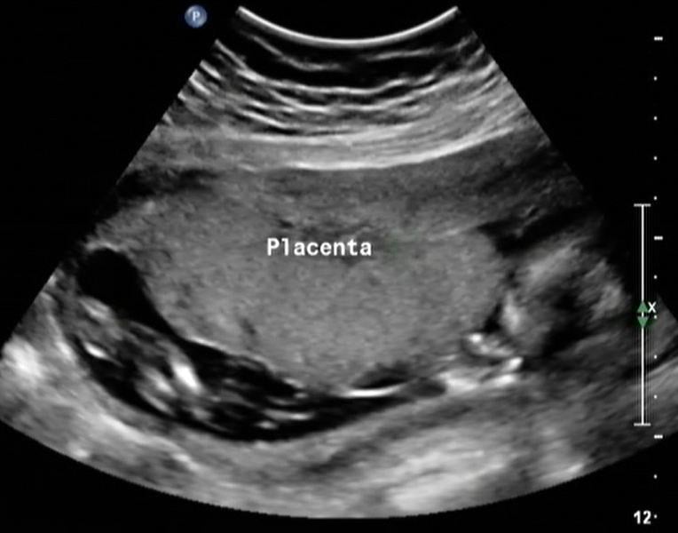 The placenta, the gray mass in the center of the image, on a fetal ultrasound picture. Katherine Fornell