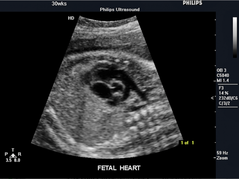 Fetal heart on ultrasound picture at 30 weeks, showing a heart valve opening. Imaged with a Philips Envisor system. 