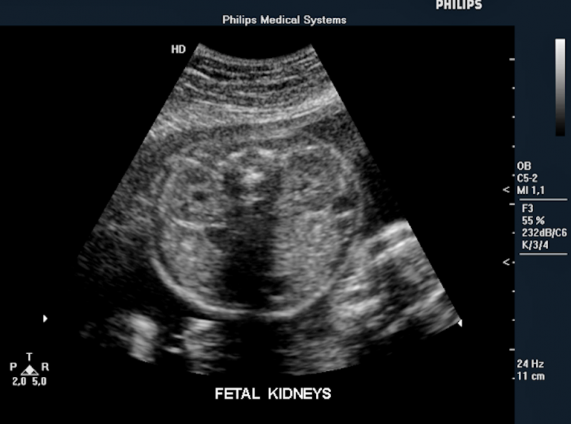 Fetal kidneys on ultrasound. Imaged with a Philips Envisor system. This is a baby ultrasound, also referred to as fetal ultrasound, OB ultrasound or prenatal ultrasound.