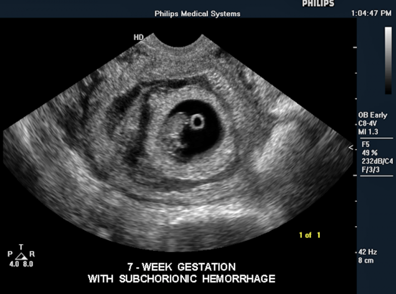 Fetal ultrasound with subchorionic hemorrhage at seven weeks. Imaged with a Philips Envisor system. This is a baby ultrasound, also referred to as fetal ultrasound, OB ultrasound or prenatal ultrasound.