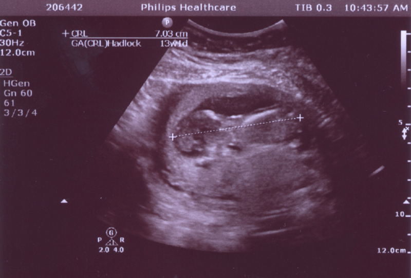 Fetal ultrasound image software includes digital calipers sonographers use to measure between two points. There are a series of standard measurements taken that are used to determine the age of the fetus and estimate the date of birth. Most newer ultrasound systems automate this feature once the measuring points are determined by the sonographer, as seen in this example of on a Philips system. Vivian Fornell. How age is determined on baby ultrasound