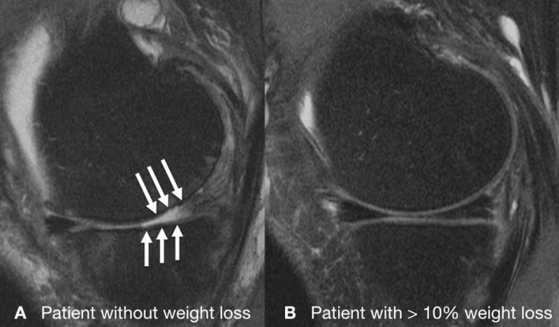 RSNA 2015, MRI study, weight loss, knee cartilage degeneration, knee joint