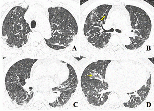 Chest CT imaging of patient. #coronavirus #nCoV2019 #2019nCoV #COVID19 