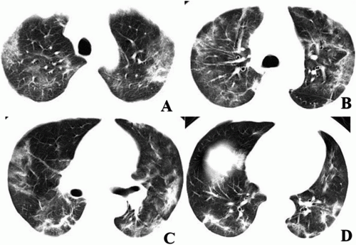 CT images showed multi-focal GGO and mixed consolidation that most appeared at peripheral area of both lungs. #coronavirus #nCoV2019 #2019nCoV #COVID19 