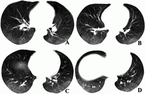 CT images showed bilateral subpleural bandlike areas of GGO compatible with viral pneumonia. #coronavirus #nCoV2019 #2019nCoV #COVID19 