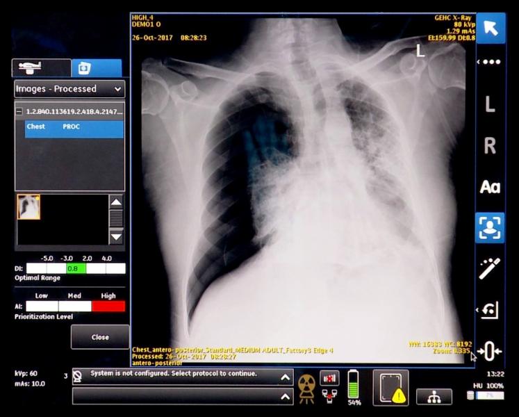 GE’s smart algorithm alerts technologist to possible complications in a chest radiograph. The combined algorithm and portable X-ray unit was shown as a work in progress at RSNA 2017.