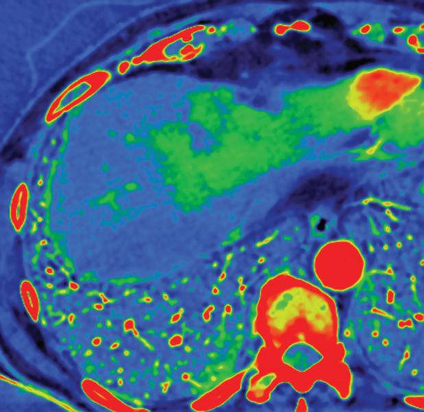 GE’s Gemstone Spectral Imaging technology (above) can help classify enhancing and un-enhancing lesions. The above image depicts a liver lesion with iodine in the arterial phase. 