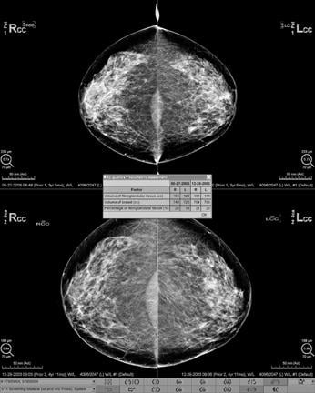 Hologic offers Quantra volumetric breast density assessment software, which uses details of the X-ray imaging chain to quantify fibroglandular tissue in the breast. It aggregates volumetric measurements from each view in a study into a concise assessment for each breast. Hologic, Quantra, volumetric breast density assessment