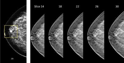 subareolar region of the breast