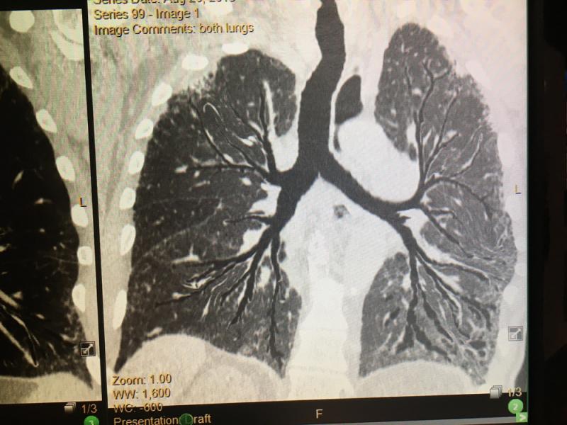  This is an artificial intelligence (AI) of a reconstructed image of lung bronchia in one image, demonstrated by the vendor Vida in its LungPrint software. Rather than needing to follow each branch on the slice the CT study. The purpose is to offer a quick view of the airways and help quickly identify any issues. This Hyperion view is also used as a reference image when the AI identifies anything in the scan, such as suspected nodules, COPD or emphysema. 