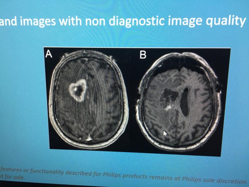 Philips Healthcare is using artificial intelligence (AI) to better reconstruct MRI images to remove artifacts and improve image quality. This example of how AI can remove MRI artifact was shown by the vendor during a booth tour at RSNA 2019,