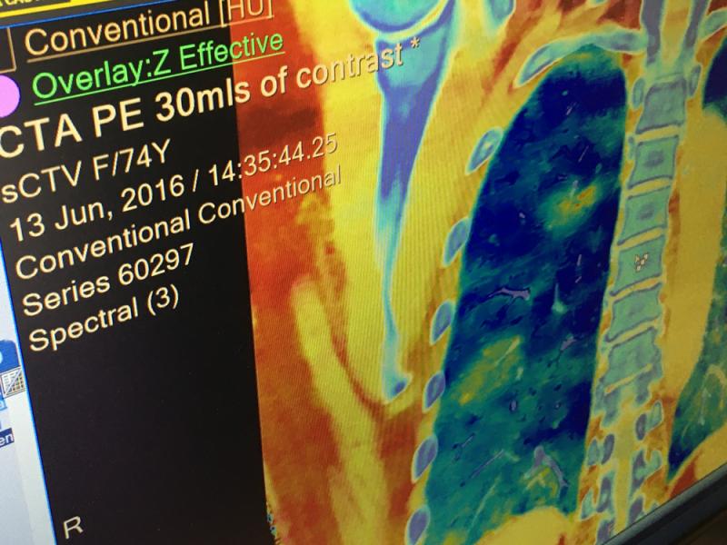 An example of Spectral CT showing locations of pulmonary embolisms (PE) using an iodine map overlaid on the CT anatomical imaging. The closeups show two PEs on the dual energy images, and how the iodine map can be leveled in and out to pinpoint areas of low or no perfusion. You can see the clots in the culprit vessel segments. This was demonstrated at the Philips booth showing images from the IQon scanner at RSNA 2019. 
