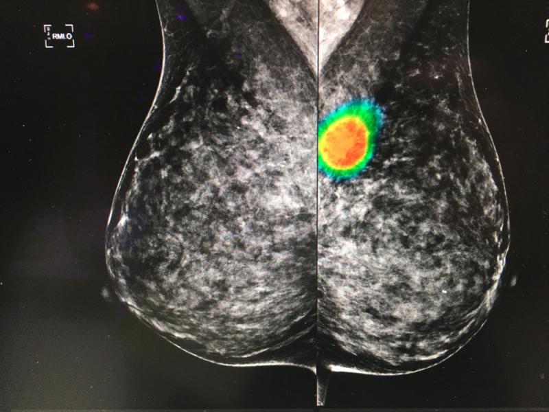 An artificial intelligence app to auto detect areas of interest on mammograms from the vendor Lunit. The software was shown as a work in progress. The AI can perform a first pass on mammograms to flag exams and bring them to the top of reading lists, acting as a second set of eyes for the radiologist. #RSNA #RSNA2019