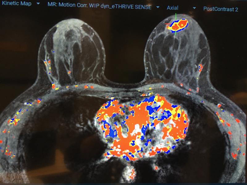 Qlarity Imaging’s QuantX artificial intelligence (AI) software is used to assist radiologists by automating the assessment and characterization of breast lesions on contrast MRI. The system has FDA clearance. #RSNA #RSNA2019