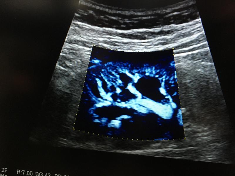An example the microvasculature visualized on Hitachi’s new ultrasound transducer CMUT Crystal technology. This is on a Arietta 850 ultrasound system.