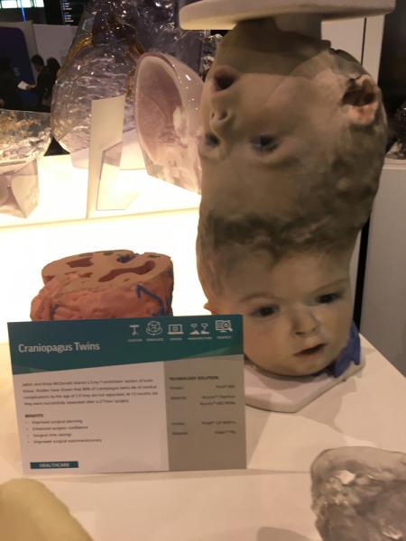 This is a case of conjoined twins attached at the head who had their complex surgeries planned with the help of 3D printing from their CT scans. They had a shared blood supply between their brains, as seen here in the pre-procedural printed scan of their heads and brains. This required several surgical procedures to separate the vessels, which are pointed out by green markers on the 3-D printed brain scans here.  This case was displayed by the vendor 3D Systems at the 2019 RSNA.