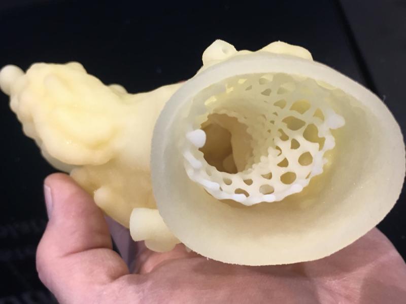 A 3-D printed CoreValve TAVR device in the aorta root created from a patient’s CT imaging. It was shown by 3D Systems at the 2019 Radiological Society Of North American (RSNA) meeting. The large radiology conference this year has a section of the expo floor devoted to 3-D printing and augmented reality.