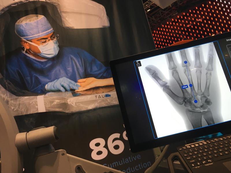 Orthoscan launched its new Tau 20/20 mini C-arm system for surgery in 2019, which the vendor says has the lowest dose available for a mini C-arm system. It has FDA indications for pediatrics and has a 20 x 20-inch detector.