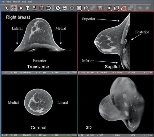 breast CT, advances in ct, advances in computed tomography, CT innovations