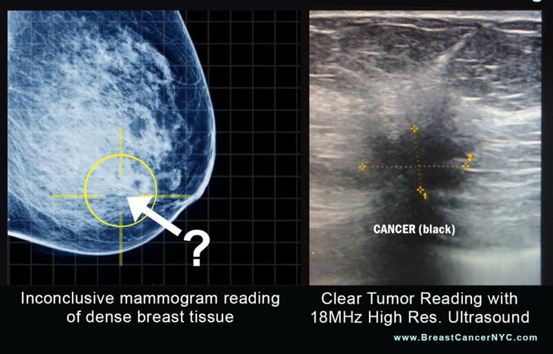 Breast image using mammogram vs. high-resolution ultrasound.